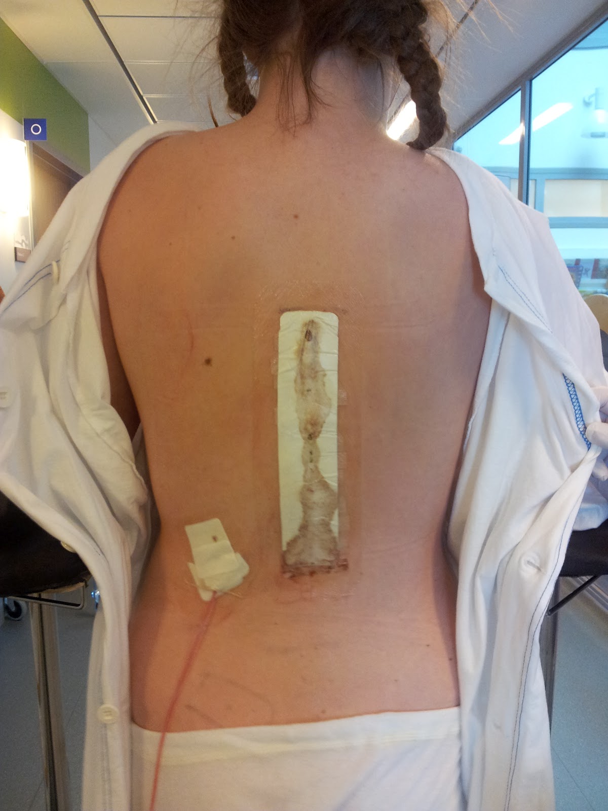 sårvätska efter operation sårvätska efter operation